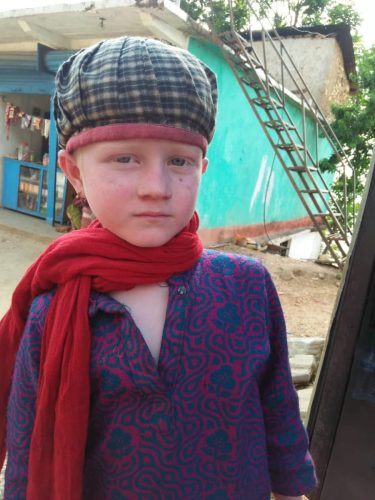 Child-living-with-albinism-in-Nepal-