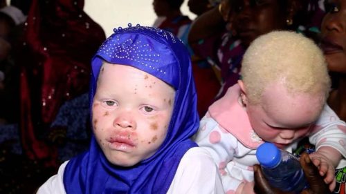 Child-with-albinism-without-proper-skincare-products