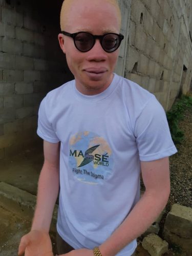 Demonstrating-confidence-as-a-person-living-with-albinism-in-Cameroon