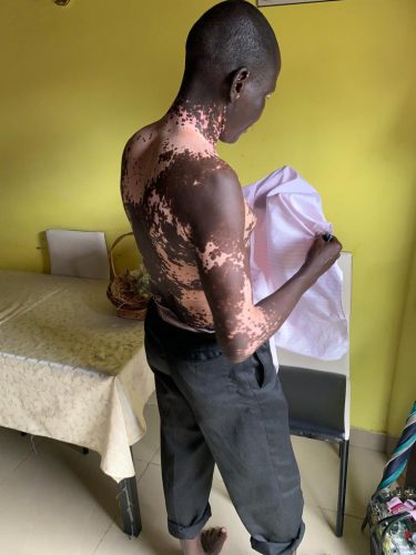 Fight-The-Stigma-vitiligo
