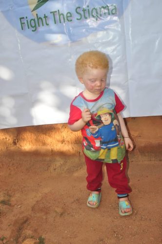 Girl-3yr-Living-with-albinism-in-Cameroon